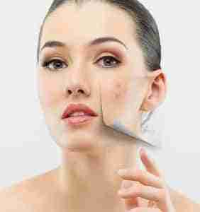 1377433473_remedy-for-acne-cNbgeV-face-acne-treatment-860X659-282x300