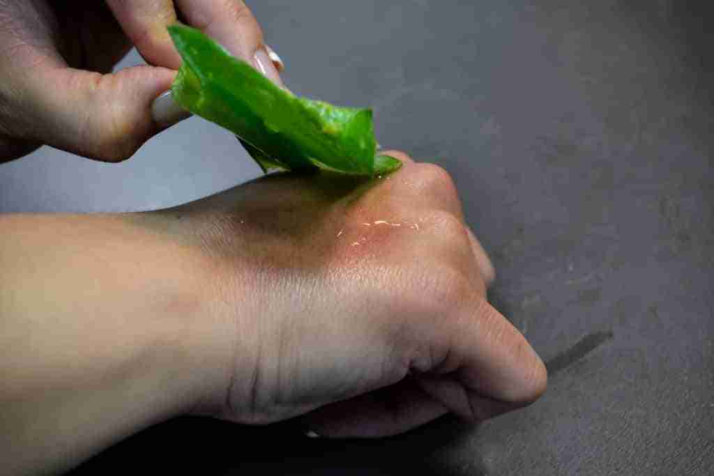 Consejos para tratar las quemaduras 1 quemaduras